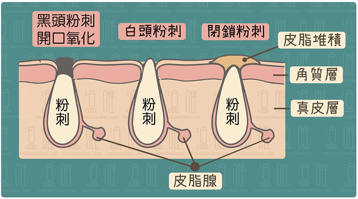pores with comedones.堵塞的毛孔.臉部清潔.洗面乳